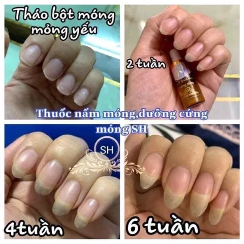 Serum Phục Hồi Móng - Combo 2 Chai 4ml Trị Nấm Móng, Hư Khoé, Bọng Móng - Giải Pháp Chăm Sóc Móng Chân Tay Hiệu Quả