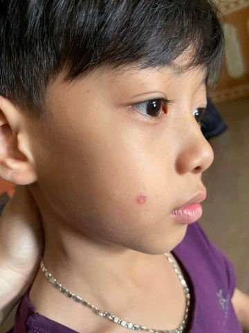 Kem Tẩy Nốt Ruồi Tàn Nhang Tại Nhà - An Toàn, Hiệu Quả Cho Mụn Thịt, Mụn Cóc, Đồi Mồi - Sản Phẩm Mỹ Phẩm Đáng Tin Cậy