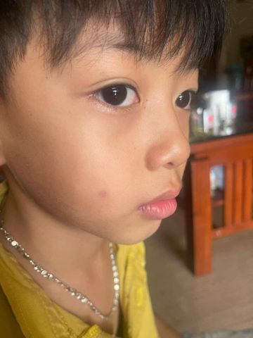 Kem Tẩy Nốt Ruồi Tàn Nhang Tại Nhà - An Toàn, Hiệu Quả Cho Mụn Thịt, Mụn Cóc, Đồi Mồi - Sản Phẩm Mỹ Phẩm Đáng Tin Cậy