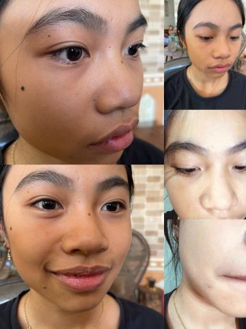 Kem Tẩy Nốt Ruồi Tàn Nhang Tại Nhà - An Toàn, Hiệu Quả Cho Mụn Thịt, Mụn Cóc, Đồi Mồi - Sản Phẩm Mỹ Phẩm Đáng Tin Cậy