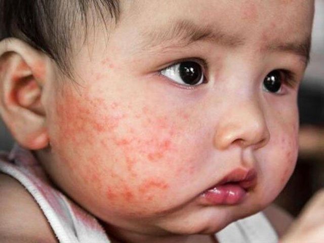 Kem Bôi Da Gia Truyền Thiên Di - Dưỡng Ẩm Da, Chữa Nứt Gót Chân, Chàm Sữa, An Toàn Cho Trẻ Sơ Sinh, Chiết Xuất Tự Nhiên