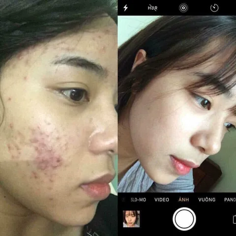 Kem Khử Mụn Hoa Đào - Thảo Dược Tự Nhiên Ngăn Ngừa Mụn, Làm Mờ Vết Thâm, Dưỡng Trắng Da cho Nam và Nữ - Chăm Sóc Da Hiệu Quả