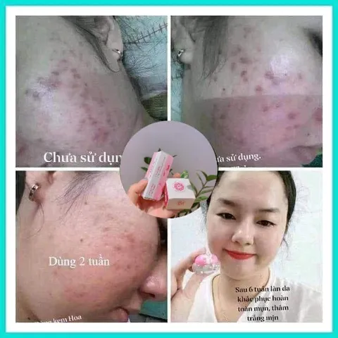 Kem Khử Mụn Hoa Đào - Thảo Dược Tự Nhiên Ngăn Ngừa Mụn, Làm Mờ Vết Thâm, Dưỡng Trắng Da cho Nam và Nữ - Chăm Sóc Da Hiệu Quả