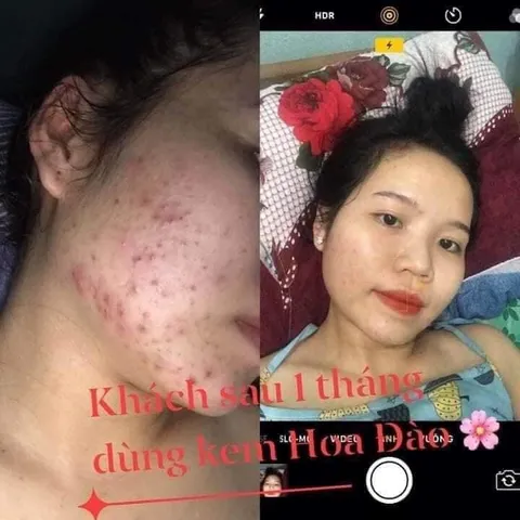 Kem Khử Mụn Hoa Đào - Thảo Dược Tự Nhiên Ngăn Ngừa Mụn, Làm Mờ Vết Thâm, Dưỡng Trắng Da cho Nam và Nữ - Chăm Sóc Da Hiệu Quả