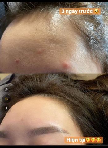 Serum Trị Mụn Handmade 10ml - Giảm Mụn Đầu Đen, Mụn Ẩn, Xóa Thâm, Sáng Da, An Toàn Cho Da Nhạy Cảm