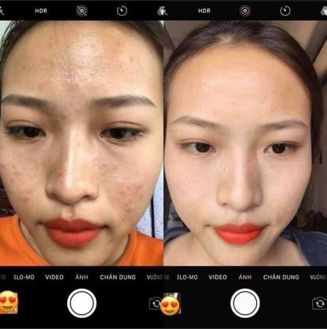 Serum Trị Mụn Handmade 10ml - Giảm Mụn Đầu Đen, Mụn Ẩn, Xóa Thâm, Sáng Da, An Toàn Cho Da Nhạy Cảm