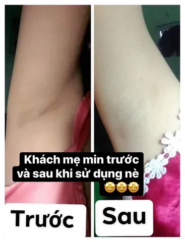 Kem Khử Mùi Hôi Nách và Làm Trắng Da Nách INOD - Sản Phẩm An Toàn, Hiệu Quả Chỉ Sau 3 Ngày Sử Dụng, 8g
