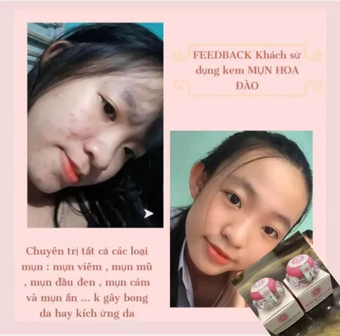 Kem Mụn Hoa Đào - Giải Pháp An Toàn Cho Da Sạch Mụn, Dưỡng Trắng Tự Nhiên, Phục Hồi Da Khô, Hiệu Quả Chỉ Sau 2 Tuần Sử Dụng