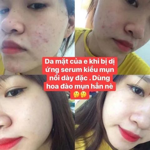 Kem Mụn Hoa Đào - Giải Pháp An Toàn Cho Da Sạch Mụn, Dưỡng Trắng Tự Nhiên, Phục Hồi Da Khô, Hiệu Quả Chỉ Sau 2 Tuần Sử Dụng