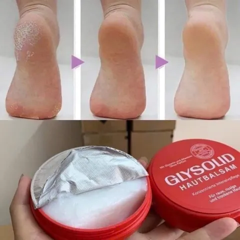 Kem Glysolid Đức dưỡng mềm da loại bỏ khô ráp nứt nẻ gót chân, tay 403321