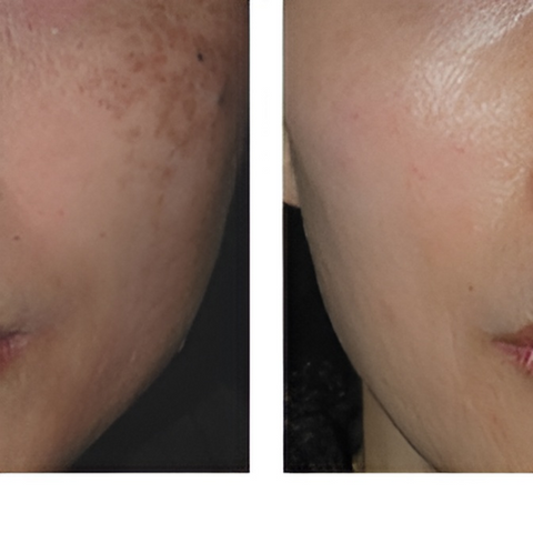 Kem loại bỏ nám Luma Nano Dark Spot Remover 20ml - Giúp làm mờ tàn nhang và đốm nâu, da sáng mịn tự nhiên