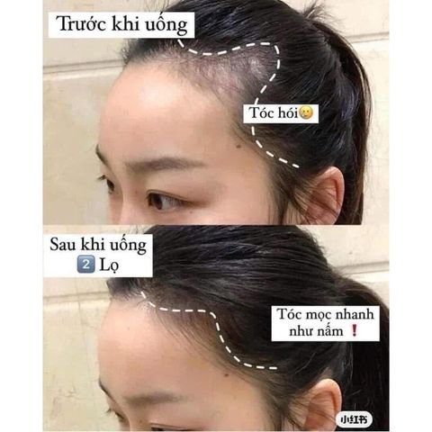 Viên Uống Hỗ Trợ Mọc Tóc Biotin 10000mcg Natrol Beauty Chính Hãng - Giúp Tóc Đẹp, Chắc Khỏe, Ngăn Rụng Tóc 100 Viên
