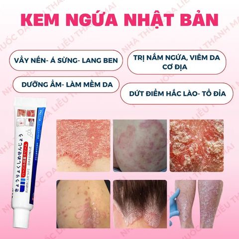 Kem Bôi Chăm Sóc Da Nhật Bản - Giảm Ngứa, Dưỡng Ẩm, Hỗ Trợ Cải Thiện Lác Đồng Tiền, Nấm Da Đầu, Á Sừng