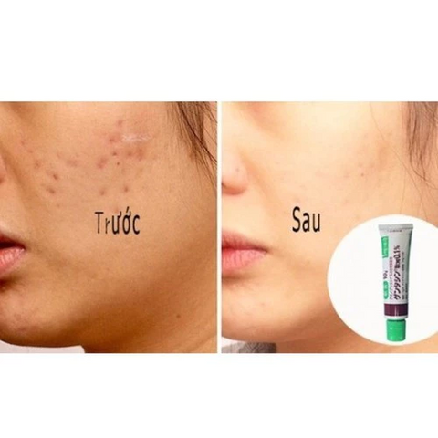 Kem Giảm Mụn, Giảm Sẹo Gentacin Inomata 10g - Hỗ Trợ Làm Lành Da, Kháng Khuẩn, Chăm Sóc Da Tổn Thương Nhật Bản