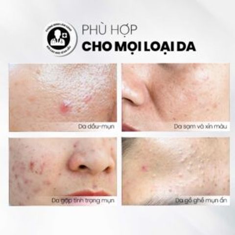 Tẩy Tế Bào Chết Kiểm Soát Dầu Mụn MD CARE AntiAc Exfo - Giảm Viêm, Sạch Da Hiệu Quả, Dành Cho Da Dầu Mụn