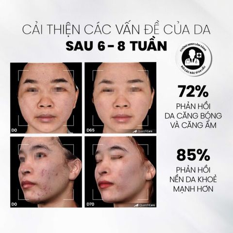 Tẩy Tế Bào Chết MD CARE Glow Exfo - Làm Sáng Da, Mờ Thâm, Cung Cấp Độ Ẩm Cho Làn Da Khỏe Mạnh