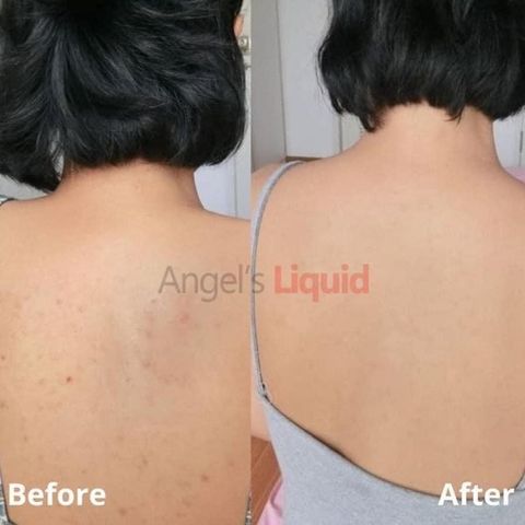 Xịt Giảm Mụn Lưng Angel's Liquid Glutathione 150ml - Giúp Làm Mờ Thâm và Ngăn Ngừa Mụn Hiệu Quả Cho Da êm Ái