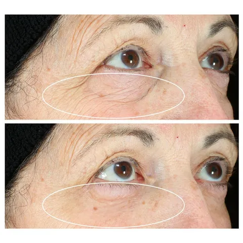 Kem Xóa Tan Bọng Mắt Hyperlift Eye™ - Sản Phẩm Chăm Sóc Da Mặt Strivectin, Giúp Xóa Nếp Nhăn, Mang Lại Vẻ Tươi Tắn Cho Đôi Mắt