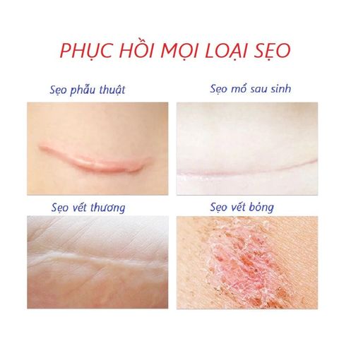 Kem Trị Nám Tàn Nhang Dưỡng Ẩm Da - Chiết Xuất Tự Nhiên & Công Nghệ Tiên Tiến Làm Mờ Sẹo, Phù Hợp Cho Mọi Loại Da