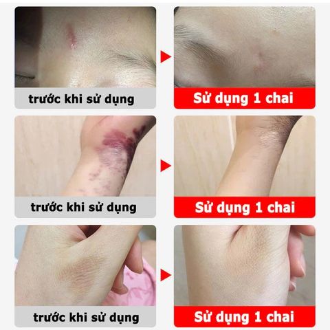 Kem Trị Nám Tàn Nhang Dưỡng Ẩm Da - Chiết Xuất Tự Nhiên & Công Nghệ Tiên Tiến Làm Mờ Sẹo, Phù Hợp Cho Mọi Loại Da