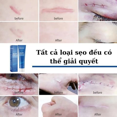 Kem Xóa Sẹo Hiệu Quả – Làm Mờ Sẹo Cũ, Sẹo Phẫu Thuật, Sẹo Mụn Trứng Cá & Vết Rạn Da, Dưỡng Da Mịn Màng, Mỹ Phẩm Hoa Kỳ