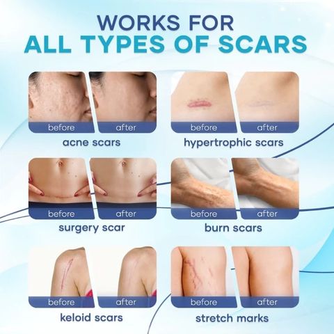 Kem Xóa Sẹo Hiệu Quả – Làm Mờ Sẹo Cũ, Sẹo Phẫu Thuật, Sẹo Mụn Trứng Cá & Vết Rạn Da, Dưỡng Da Mịn Màng, Mỹ Phẩm Hoa Kỳ