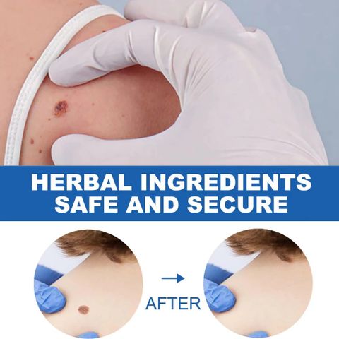 Kem Tẩy Nốt Ruồi & Mụn Cóc - Giải Pháp Làm Sạch Da Hiệu Quả, Dễ Sử Dụng, Chăm Sóc Da Toàn Diện