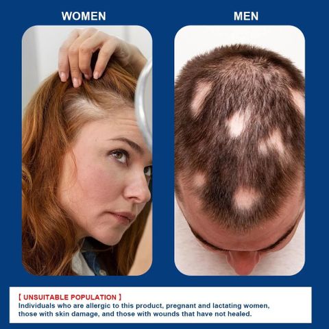 Kem Mọc Tóc Alopecia Hair Growth Cream - Kích Thích Mọc Tóc, Giảm Gãy Rụng, Nuôi Dưỡng Tóc Chắc Khỏe 20g