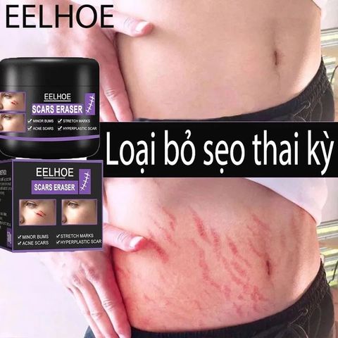 Kem Xóa Sẹo EELHOE - Giải Pháp Hiệu Quả Xóa Sẹo Lâu Năm, Phẫu Thuật và Rạn Da Sau Mang Thai