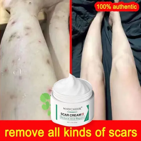 Kem Mờ Sẹo 50g - Giúp Làm Mờ Sẹo Thâm, Sẹo Mụn, Nuôi Dưỡng Da Mềm Mại - Sản Phẩm Chất Lượng Từ Thụy Sĩ