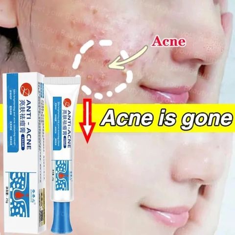 Gel Loại Bỏ Mụn - Kem Giảm Mụn Nhanh 25g, Hỗ Trợ Mờ Vết Thâm, Kiểm Soát Dầu, Phục Hồi Da, Sản Phẩm Chăm Sóc Da Chất Lượng