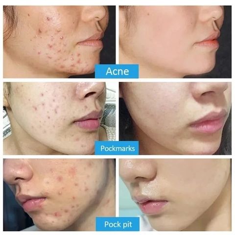 Gel Loại Bỏ Mụn - Kem Giảm Mụn Nhanh 25g, Hỗ Trợ Mờ Vết Thâm, Kiểm Soát Dầu, Phục Hồi Da, Sản Phẩm Chăm Sóc Da Chất Lượng