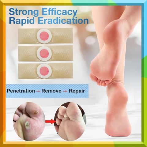 Gói 30 Miếng Dán Loại Bỏ Mụn Cóc - Gel Chăm Sóc Chân Ngón, Độ Mạnh Tối Đa, Giải Pháp Hiệu Quả Không Đau Đớn