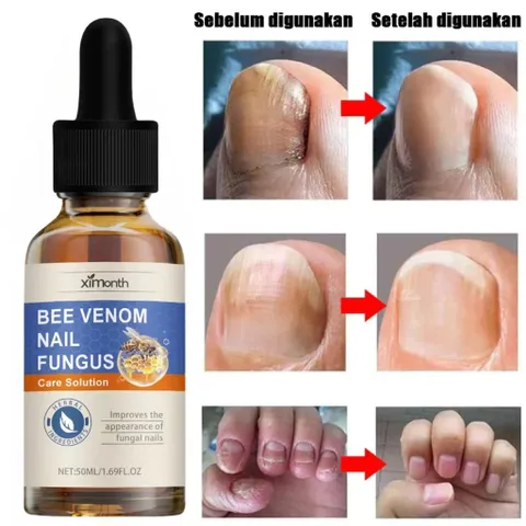 Tinh Chất Loại Bỏ Nấm Móng 50ML - Kem Phục Hồi Móng Tay, Chân Kháng Khuẩn, Chăm Sóc Móng Yếu, Hỗ Trợ Khôi Phục Sức Khỏe Móng