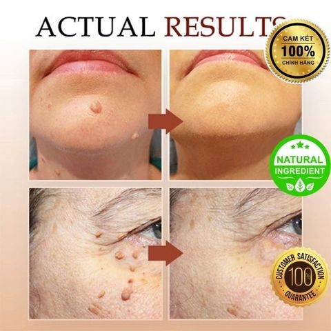 Bút Tẩy Nốt Ruồi & Xóa Mụn Thịt - Sản Phẩm Chăm Sóc Da Thiên Nhiên, Không Đau Rát, Hiệu Quả Nhanh Chóng