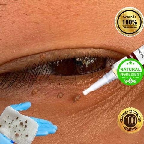 Bút Tẩy Nốt Ruồi & Xóa Mụn Thịt - Sản Phẩm Chăm Sóc Da Thiên Nhiên, Không Đau Rát, Hiệu Quả Nhanh Chóng
