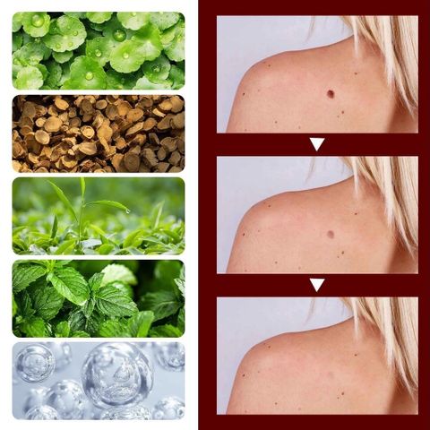 Bút Tẩy Nốt Ruồi & Xóa Mụn Thịt - Sản Phẩm Chăm Sóc Da Thiên Nhiên, Không Đau Rát, Hiệu Quả Nhanh Chóng