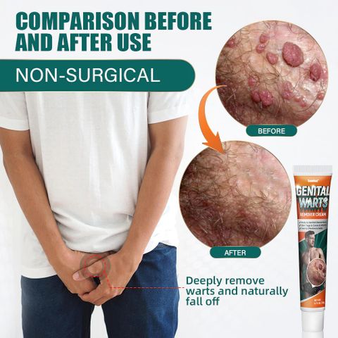 Kem Bôi Giảm Ngứa Vùng Kín SUMIFUN - Tinh Chất Thảo Mộc Hỗ Trợ Chăm Sóc Nấm, Mụn Sinh Dục, Sùi Mào Gà, 50g