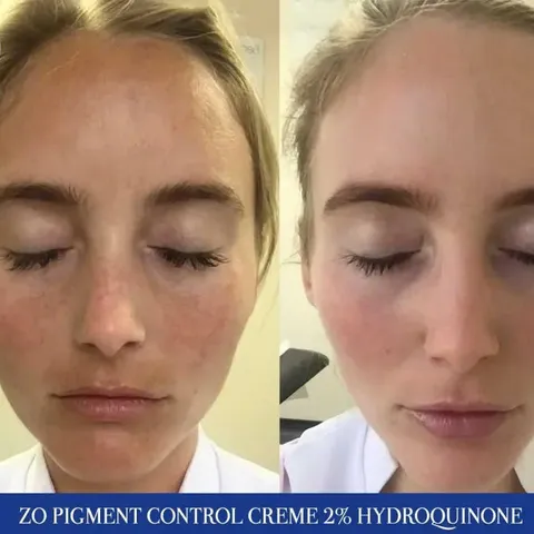 Bộ đôi Kem giảm nám ZO Pigment Control + Blending Creme 2% HQ - Giải pháp làm sáng da chuyên sâu từ Zo Skin Health