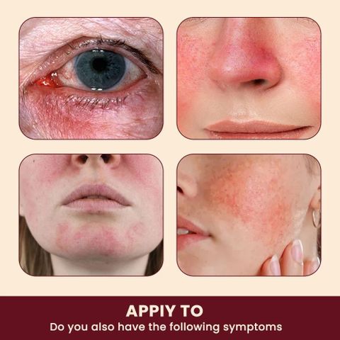 Kem Bôi Mũi Đỏ Rosacca - Giải Pháp Thảo Mộc 100% Cho Da Nhạy Cảm, Dị Ứng, Viêm Da Mặt, Hỗ Trợ Làm Dịu, Phục Hồi Da Tổn Thương