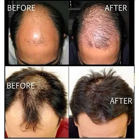 Dung Dịch Kích Tóc Rogaine 5% Minoxidil Cho Nam - Giải Pháp Hiệu Quả Cho Tình Trạng Rụng Tóc, Phục Hồi Mái Tóc Khỏe Đẹp