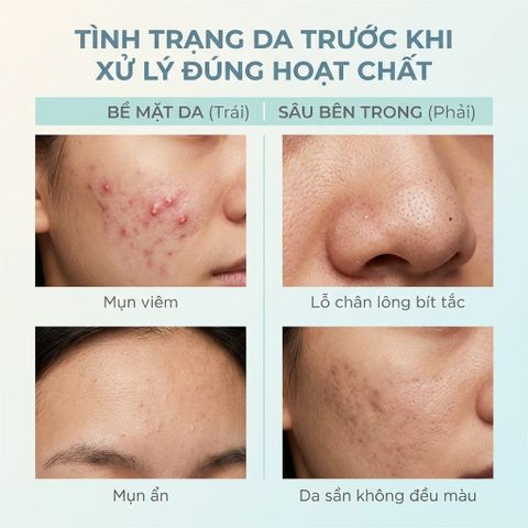 Serum La Roche-Posay Effaclar 30ml - Tinh Chất Giảm Mụn, Mờ Thâm, Thu Nhỏ Lỗ Chân Lông Cho Da Dầu Mụn, Mỹ Phẩm Pháp