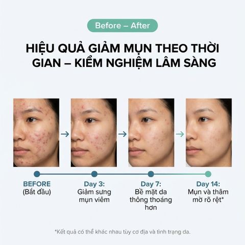 Serum La Roche-Posay Effaclar 30ml - Tinh Chất Giảm Mụn, Mờ Thâm, Thu Nhỏ Lỗ Chân Lông Cho Da Dầu Mụn, Mỹ Phẩm Pháp