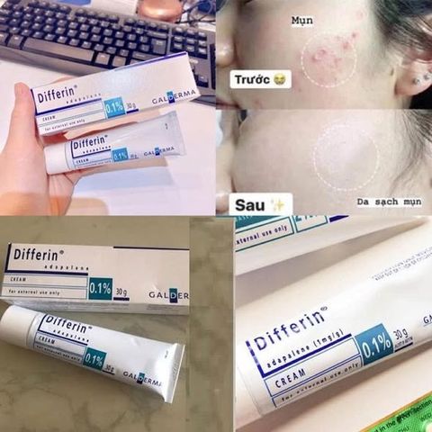 Kem Giảm Mụn Diffe..0.1% 30g dạng kem –  mụn ẩn, giảm viêm đỏ