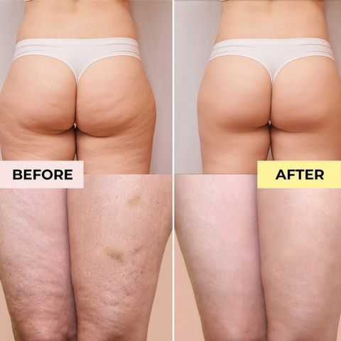 Kem Somatoline Cosmetic 250ml - Gel-Cream Giảm Cellulite, Hỗ Trợ Săn Chắc Da, Chăm Sóc Vùng Đùi & Mông, Sản Phẩm Nhập Khẩu Ý