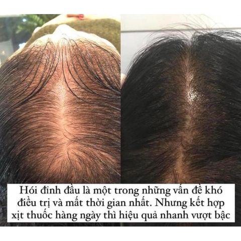 Xịt mọc tóc Minoxidil 5% BAILLEUL - Giảm rụng tóc, kích thích mọc tóc hiệu quả cho nam và nữ - Best Seller Pháp