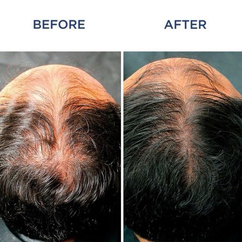Serum Mọc Tóc Nam Phyto Phytocyane - Ngăn Rụng Tóc, Kích Thích Tăng Mật Độ Tóc, Hộp 12 Ống 7.5ml, Dưỡng Tóc Chắc Khỏe