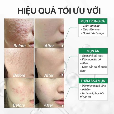 Tinh Chất Giảm Mụn Mờ Thâm SVR Sebiaclear Flash Ampoule 30ML - Dưỡng Da Nhạy Cảm, Giảm Mụn, Đỏ và Vết Thâm, Hiệu Quả Nhanh Chóng