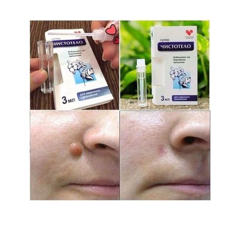 Gel tẩy nốt ruồi Dvelinil 3ml - Chuyên biệt loại bỏ mụn cóc, sẹo lồi, mụn thịt  - Xuất xứ Nga