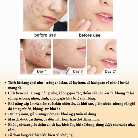 Gel Trị Mụn Nhanh - Hỗ Trợ Giảm Mụn Trong 3 Ngày, Kiểm Soát Dầu, Làm Mờ Vết Thâm Da - Sản Phẩm Cho Da Dầu, Da Dễ Nổi Mụn